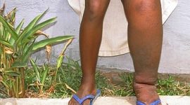 Kaki gajah atau filariasis.
