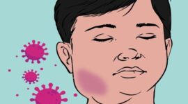 Ilustrasi Sakit Gondok.